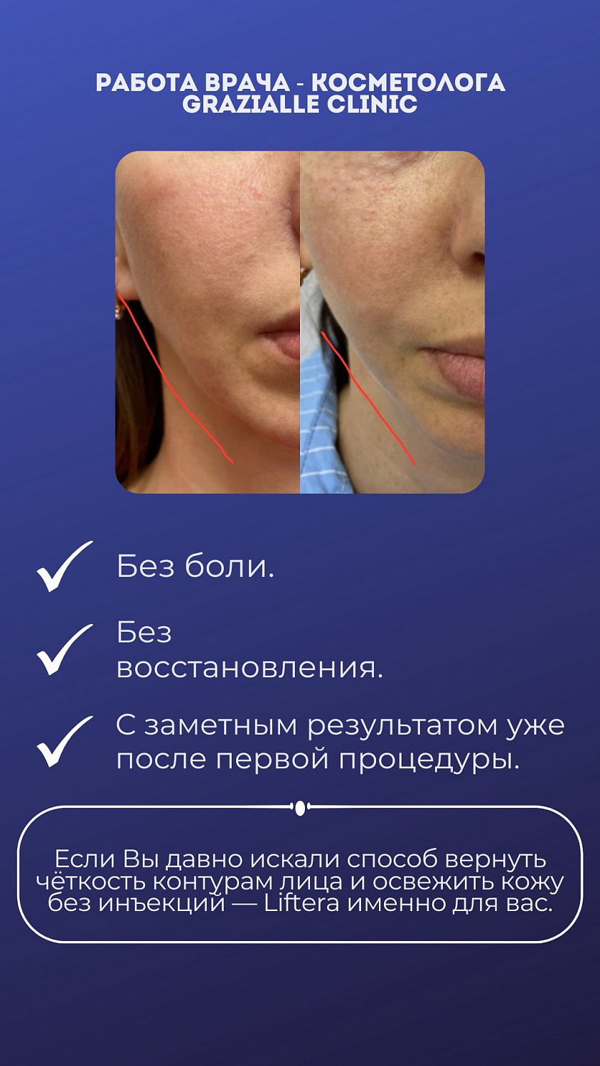 Верните чёткий овал лица: SMAS-лифтинг Liftera со скидкой 50%!